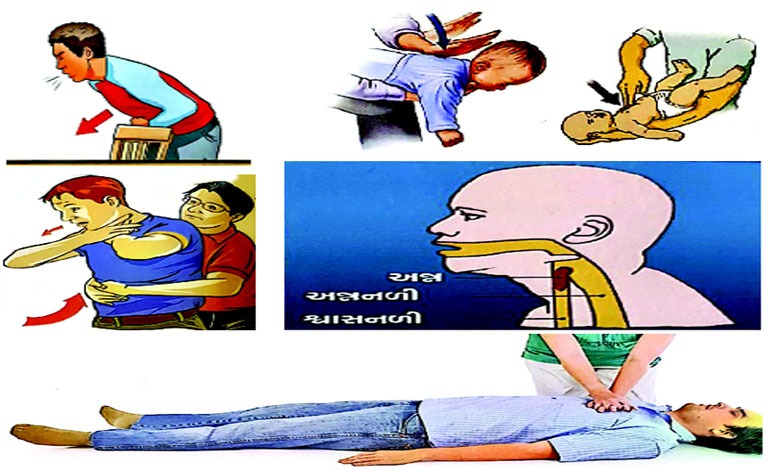 આરોગ્ય પ્લસઃ પ્રાથમિક સારવાર શ્રેણી શ્વાસ ગૂંગળાવા માંડે ત્યારે...